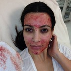 Kim Kardashian tries the Vampire Facelift on live TV