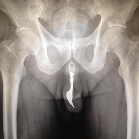 Man with fork in his penis